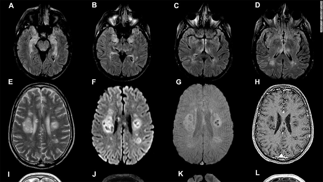 Brain scans from the University College London study, published on July 8.