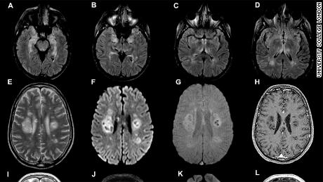 Hersenscans van de studie van University College London, gepubliceerd op 8 juli.